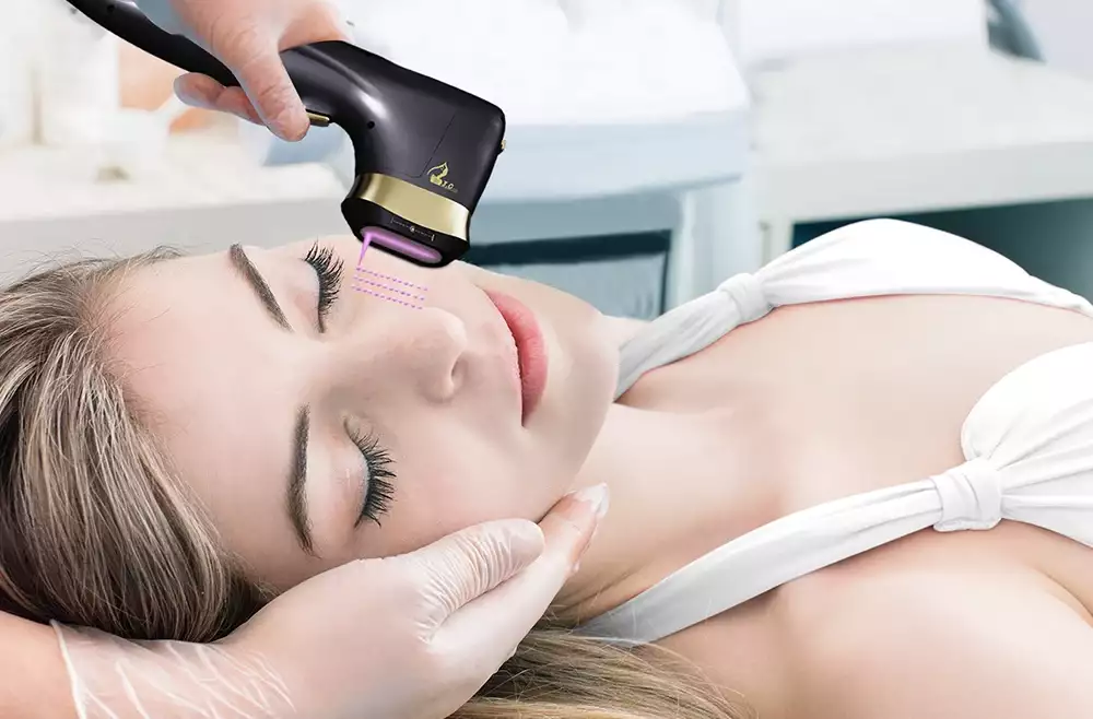 HIFU 22D – Ultherapy – Lipo Papada