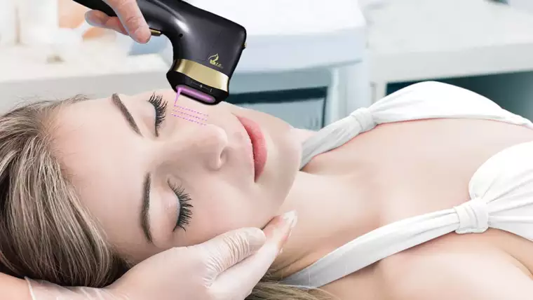 HIFU 22D – Ultherapy – Lipo Papada