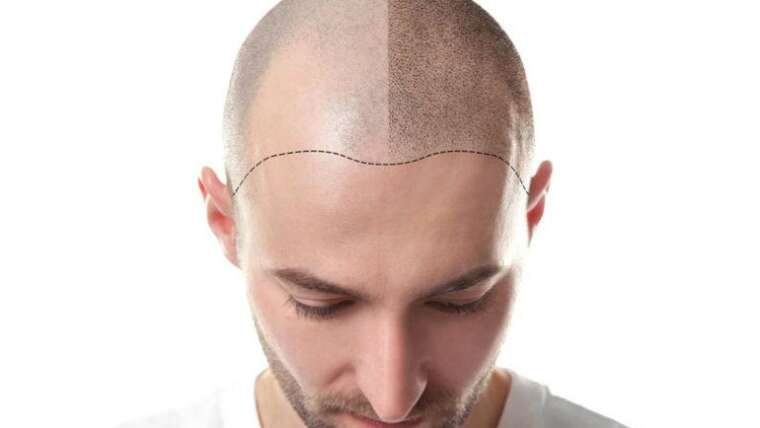 Micropigmentación