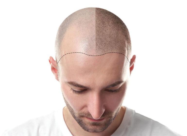 Micropigmentación