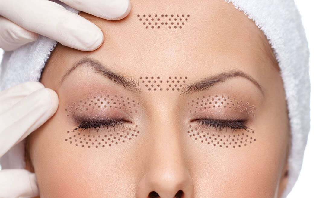 Plasma Pen: FibroPlast, PlasmLift facial