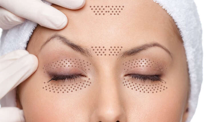 Plasma Pen: FibroPlast, PlasmLift facial