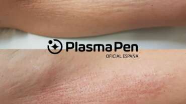 Plasma Pen: Plasmlift o FibroPlast, HIFU