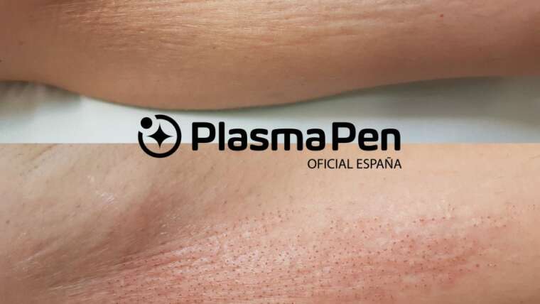 Plasma Pen: Plasmlift o FibroPlast, HIFU
