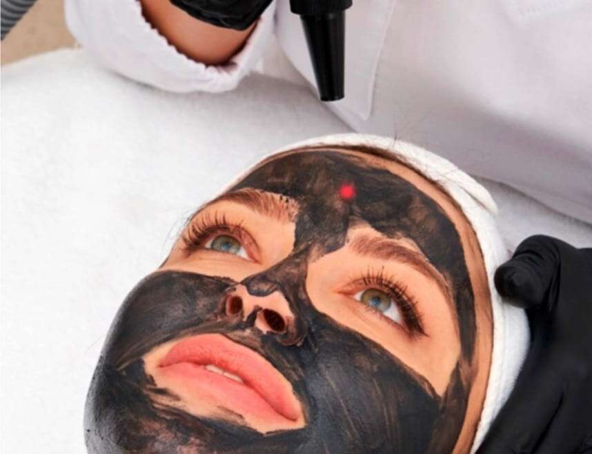 Hollywood peel, Peeling de Carbón con láser