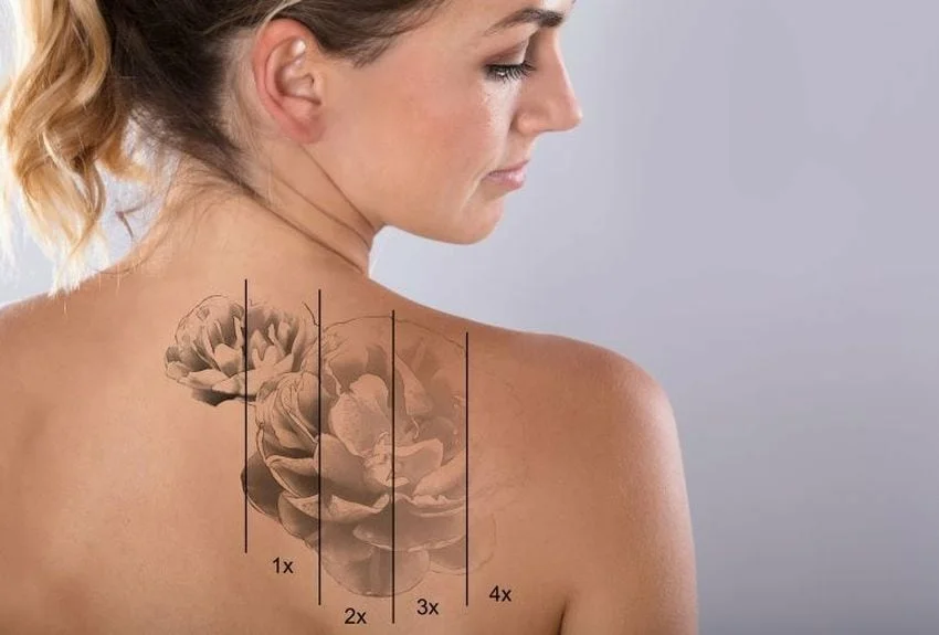 Eliminación de tatuajes y Eliminación de Micropigmentación Cejas con láser