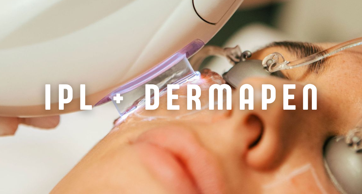 IPL + Dermapen: La combinación perfecta para una piel más luminosa, uniforme y rejuvenecida