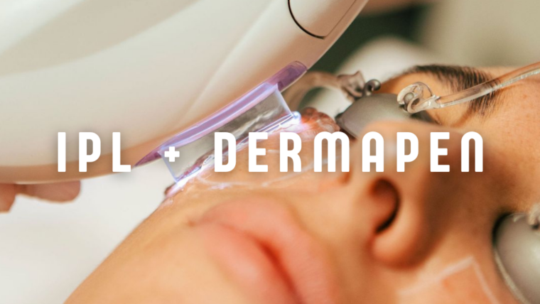 IPL + Dermapen: La combinación perfecta para una piel más luminosa, uniforme y rejuvenecida